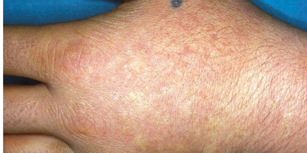 Akute lichtempfindliche Reaktion bei der Erbkrankheit. Erythropoetischen Protoporphyrie (EPP). Forscher von der ETH Z&uuml;rich sch&uuml;ren berechtigte Hoffnungen, die Krankheit gleichsam durch eine genetische Reparatur durch RNA zu besiegen. (Wikicommons)