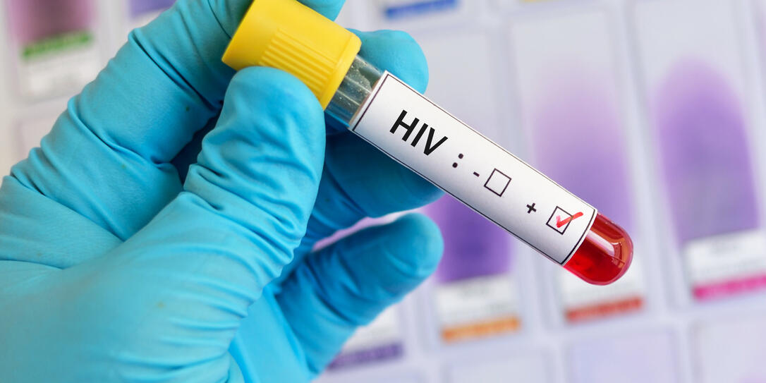 HIV positive blood sample HIV positive blood sample