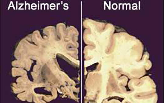 Im Gehirn eines Menschen mit Alzheimer (links): Die Grosshirnrinde schrumpft - mit drastischen Folgen für die Betroffenen. (Archivbild)