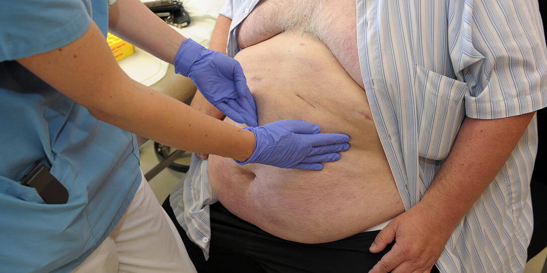 Adipositas Patienten, dicker Bauch, breit, Rollstuhl, Vergleich, Fettsüchtige, f Gesundheit, Ernährung, Adipositas, lnw, Übergewicht, Fettleibigkeit