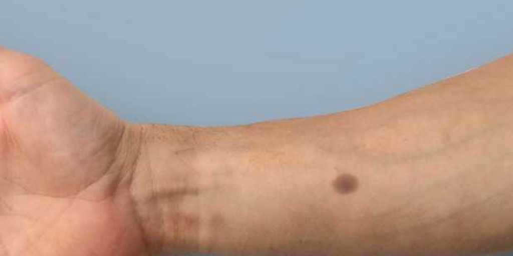 Der Leberfleck bildet sich über dem Implantat, wenn der Kalziumpegel im Blut über längere Zeit einen gewissen Schwellenwert übersteigt. Dies könnte als Früherkennung von Tumoren dienen. (Bildmontage)