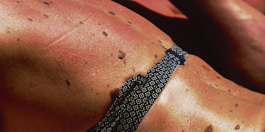 Sun freckles