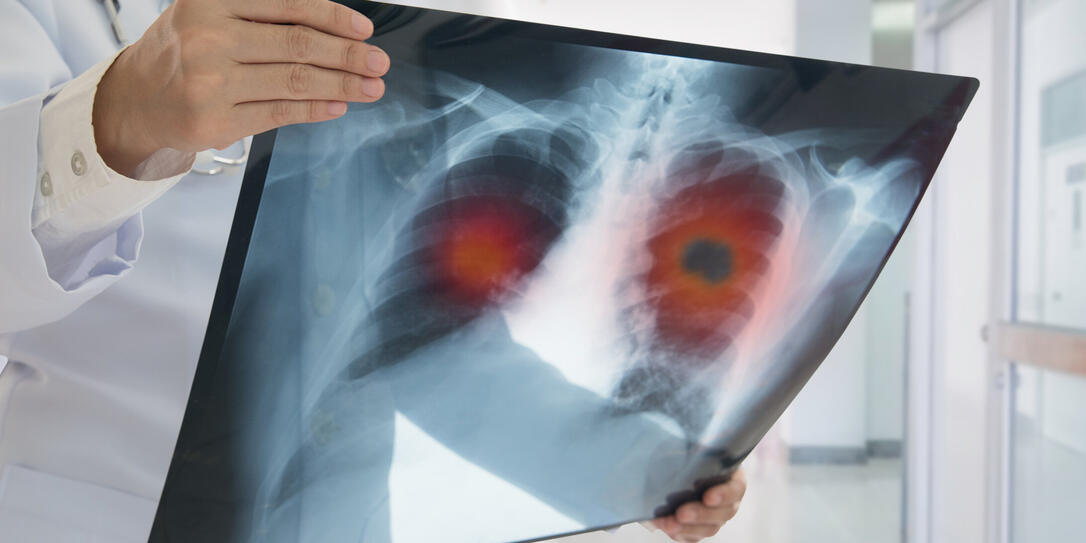 x-ray lung cancer