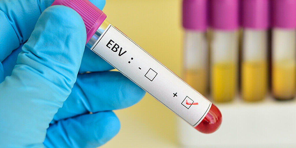 Blutprobe, die positiv auf das Epstein-Barr-Virus (EBV) getestet wurde. Sein Träger - sofern er auch über die Genvariation HLA-DR15 verfügt - ist stark gefährdet, an Multipler Sklerose zu erkranken (Bild: UZH)
