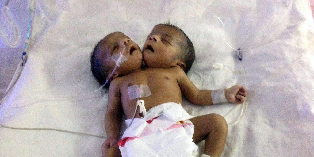 Das Mädchen - hier in der Intensivstation eines Spitals in der Hauptstadt Dhaka - wurde mit zwei Köpfen geboren