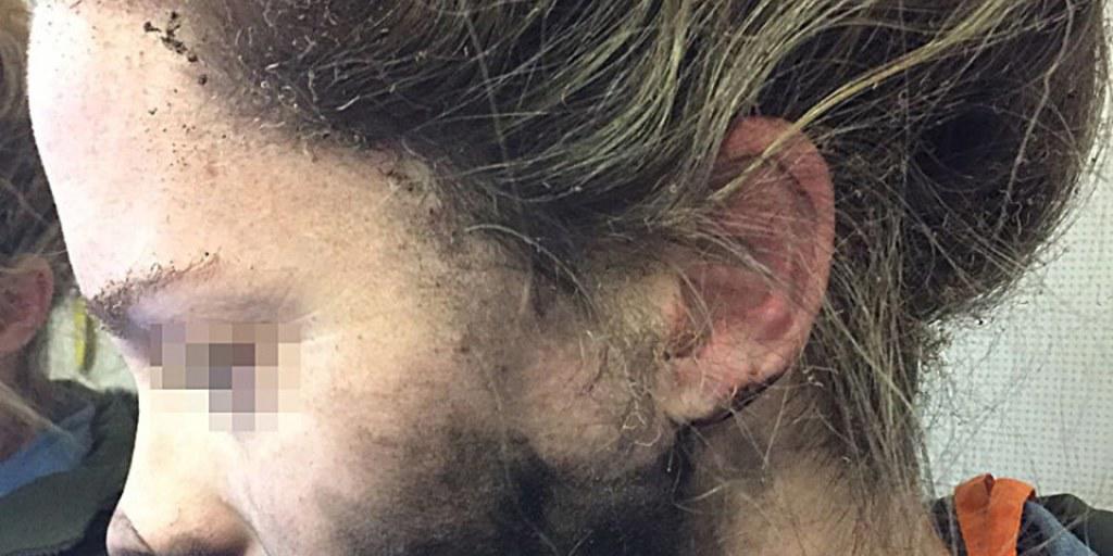 Verkohltes Gesicht und versengte Haare: Einer Australierin explodierte während eines Fluges der Kopfhörer.