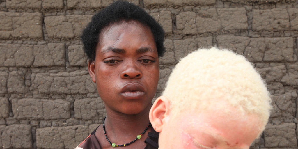 In Afrika werden Albinos vielerorts verfolgt und ermordet. Das EU-Parlament fordert die afrikanischen Staaten auf strenger dagegen vorzugehen. (Symbolbild)