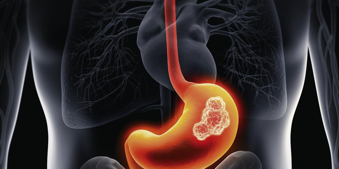 Body with stomach tumor Body with stomach tumor