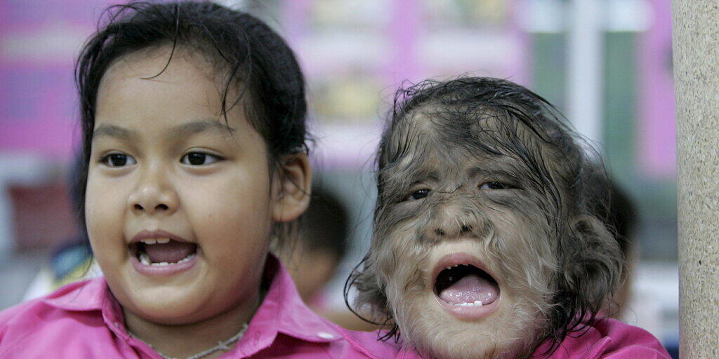 Eine Schülerin mit dem sogenannten "Werwolf-Syndrom" (Hypertrichose) in Thailand. (Archivbild)