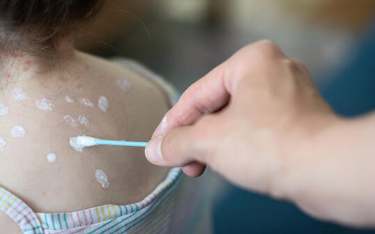 Mother taking care of little girl with chicken pox