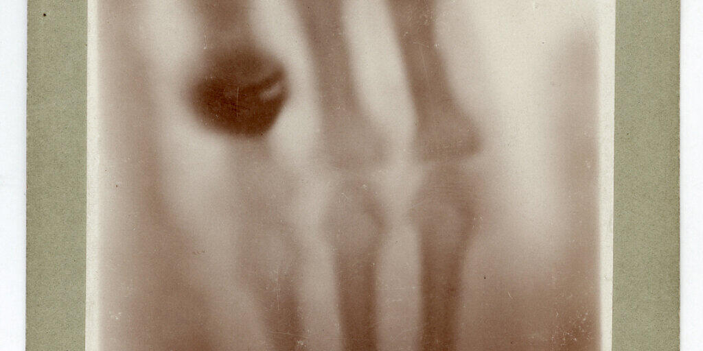 Die Hand von Anna Bertha Röntgen in einer Röntgen-Aufnahme vom 22. Dezember 1895: Das Bild zeigt ihre Handknochen mit dem Fingerring, den sie damals trug. Die Hand von Anna Bertha Röntgen in einer Röntgen-Aufnahme vom 22. Dezember 1895: Das Bild zeigt ihre Handknochen mit dem Fingerring, den sie damals trug.